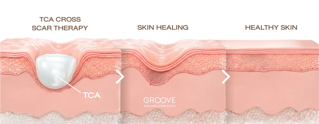 TCA Cross แต้มกรดเฉพาะจุดที่ก้นหลุมสิว — Groove Skin & Laser Clinic