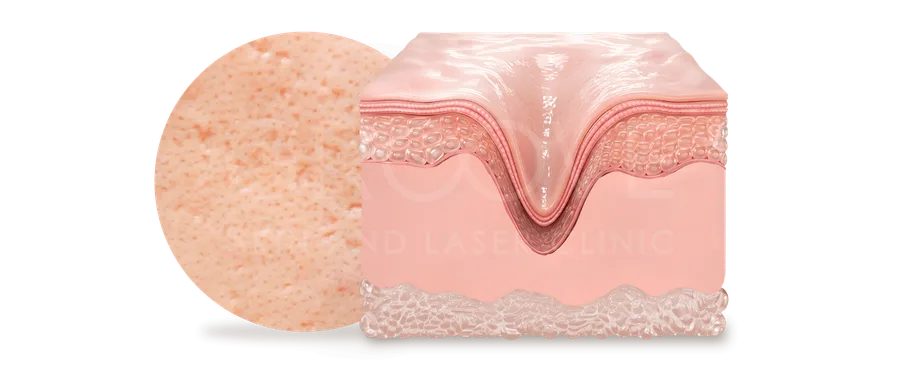 หลุมสิวแบบจิก Ice Pick Scar — Groove Skin & Laser Clinic