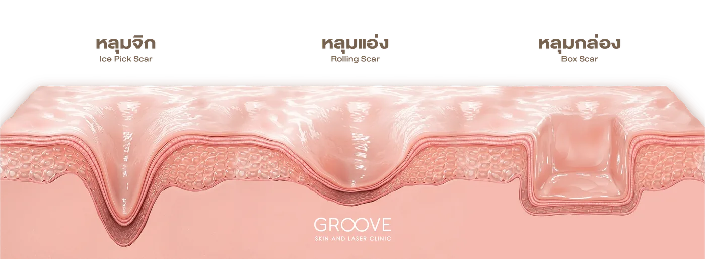 ภาพรวม 3 ประเภทหลุมสิว — Groove Skin & Laser Clinic