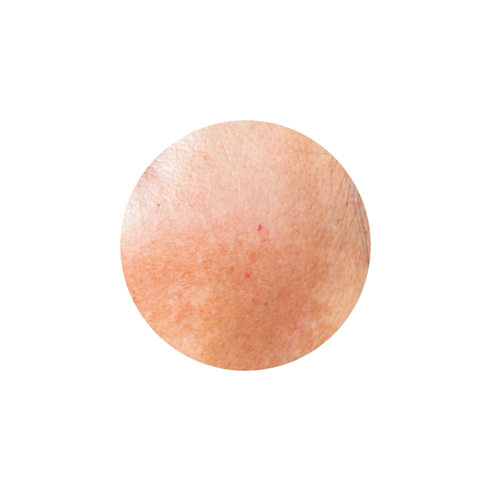 ฝ้าผสม (Mixed Melasma)