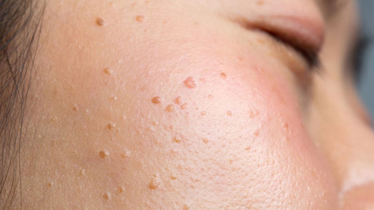 กระเนื้อ (Seborrheic Keratosis)