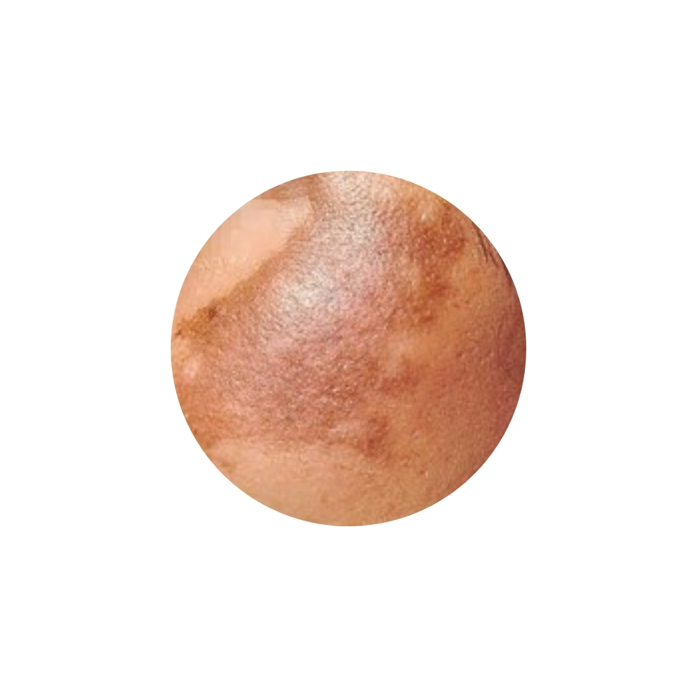 ฝ้าลึก (Dermal Melasma)