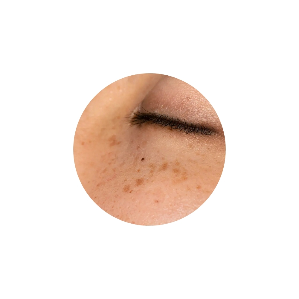 ฝ้าตื้น (Epidermal Melasma)