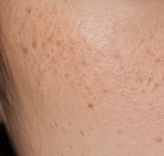 กระตื้น (freckle)