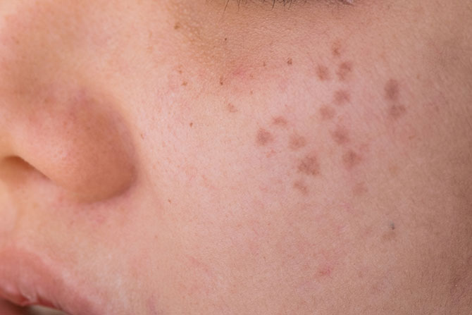 กระลึก (Hori's Nevus)