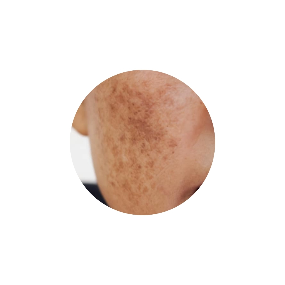 ฝ้าแดด