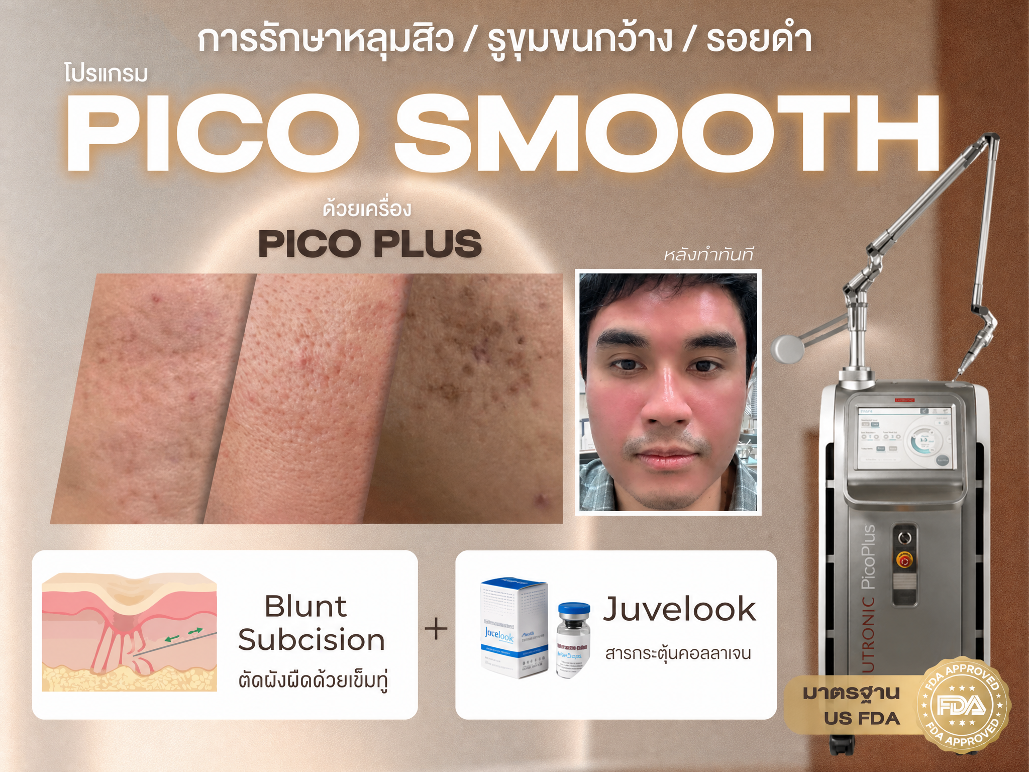 โปรแกรม PICO 2