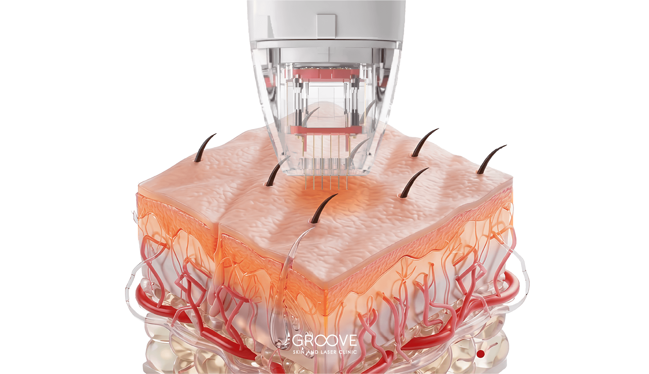 Non-Ablative energy base device