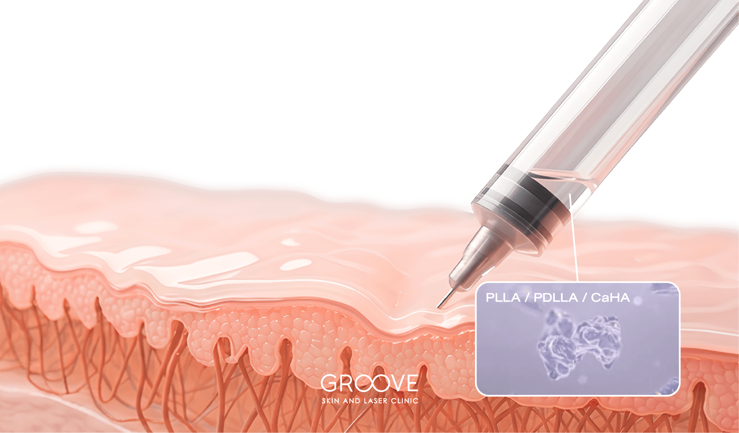 Biostimulator - collagen injection