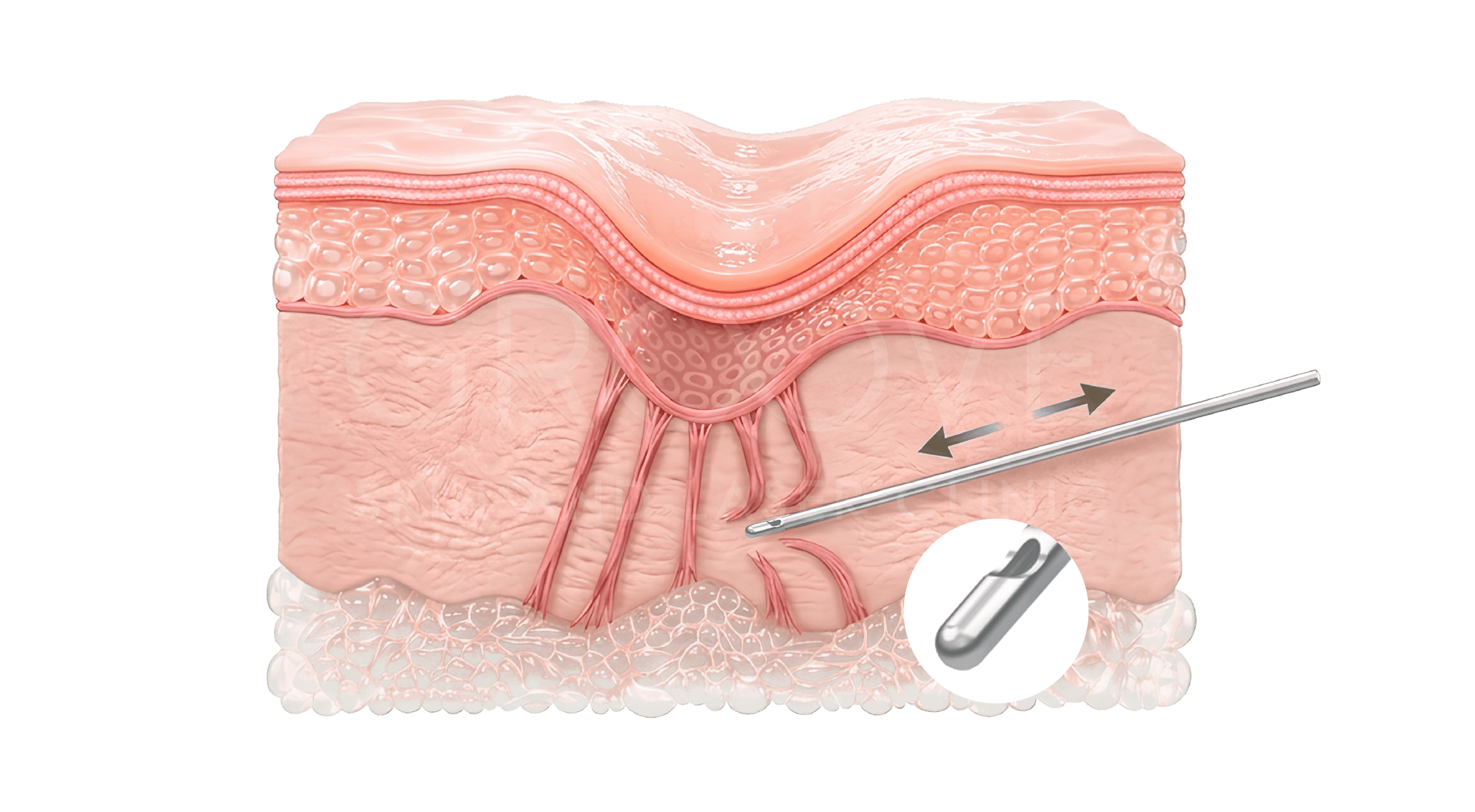 Subcision