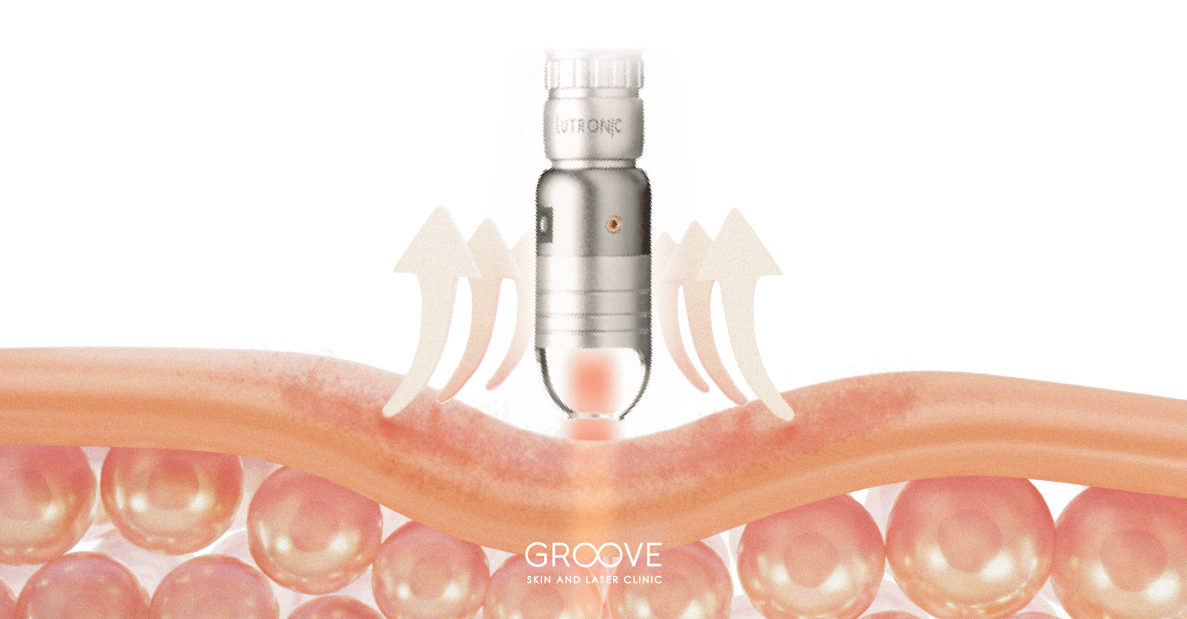 Ablative energy base device