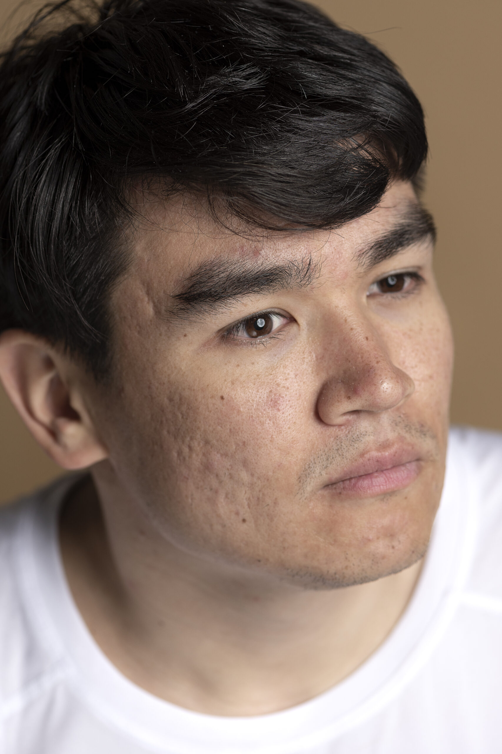 หลุมสิว