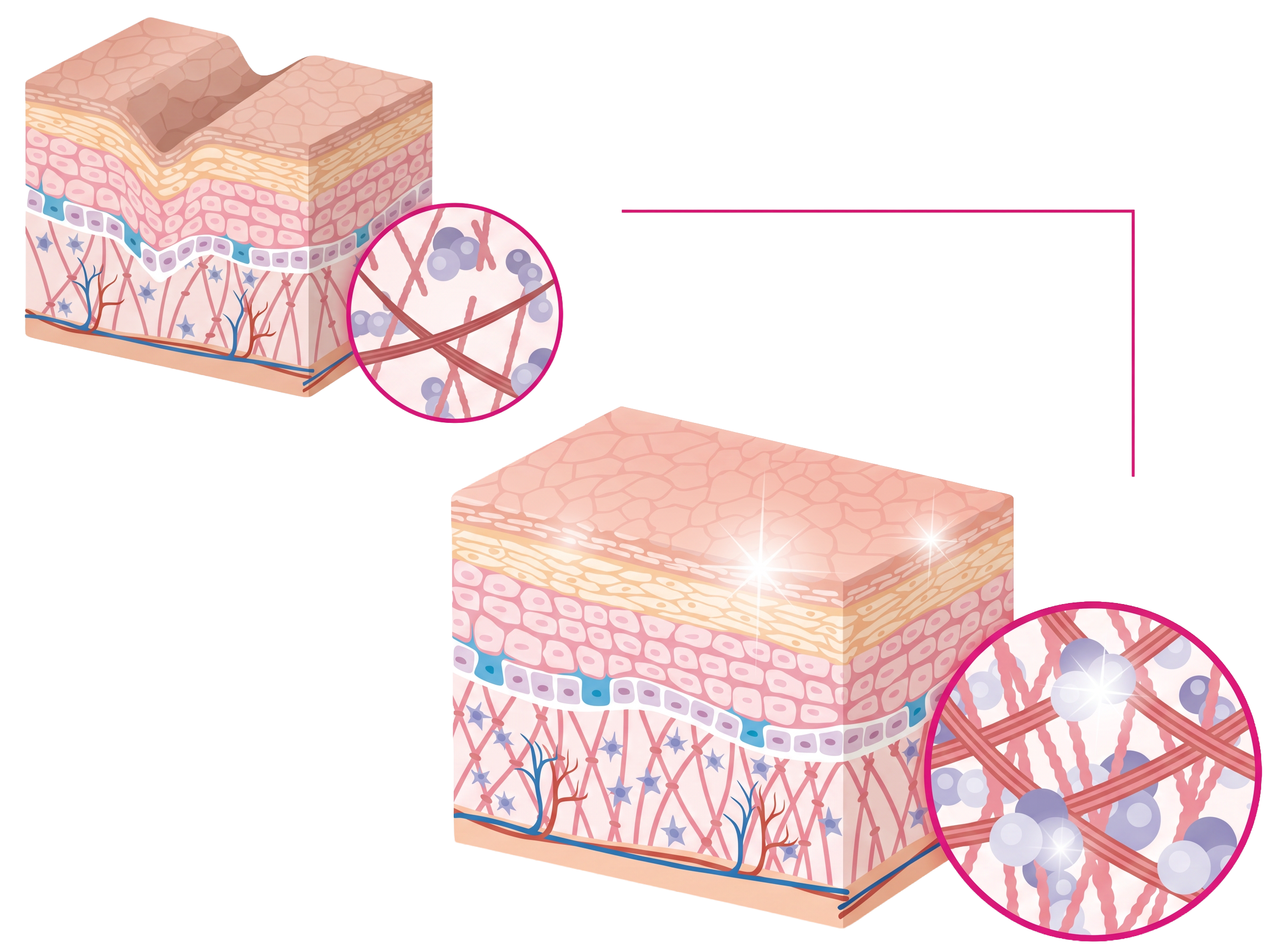 สร้างคอลลาเจนใหม่ระยะยาว (Neocollagenesi